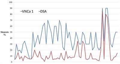 Dual Energy Computed Tomography of Internal Carotid Artery: A Modified Dual-Energy Algorithm for Calcified Plaque Removal, Compared With Digital Subtraction Angiography